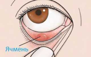 Как эффективно лечить ячмень на глазу